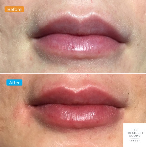 Lip filler